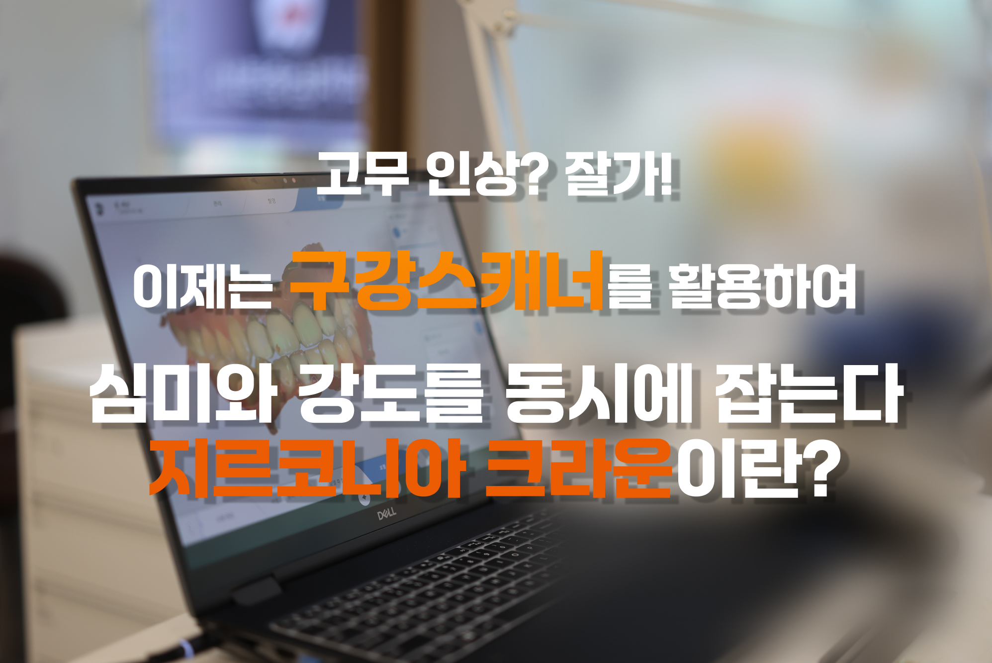고무 인상 없이 구강스캐너로 만드는 지르코니아 크라운 - 궁내동 치과