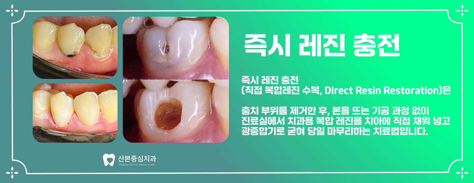 재궁동치과 즉시 레진 충전 치료 – 산본중심치과