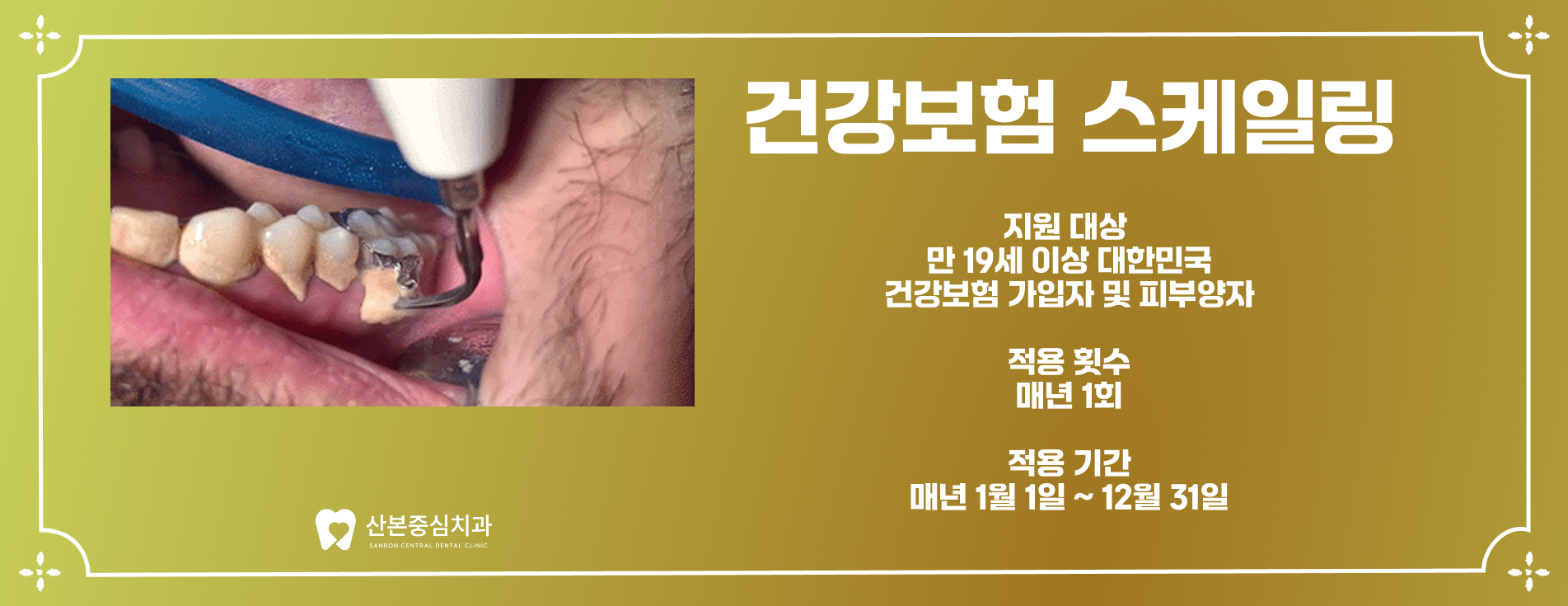 스케일링 시술 장면 - 오금동 치과