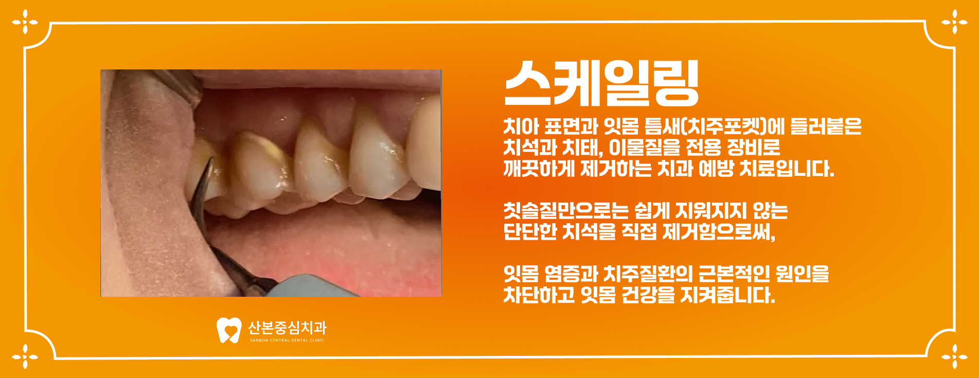 스케일링 치료 안내 - 산본중심치과