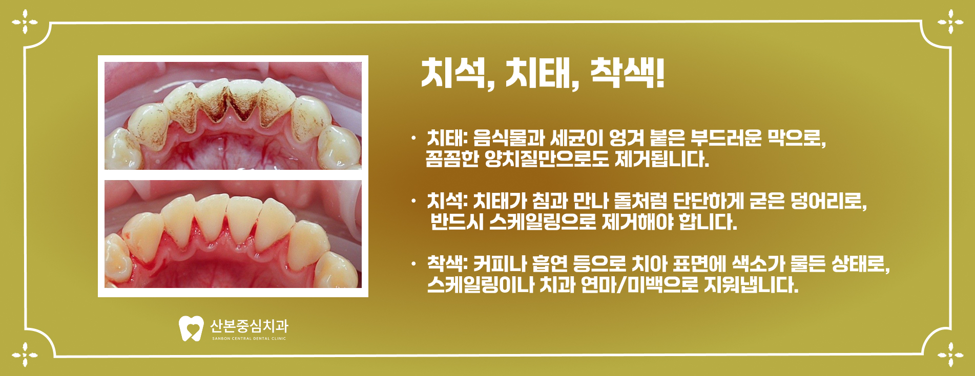 치석 치태 착색 설명 - 오금동 치과