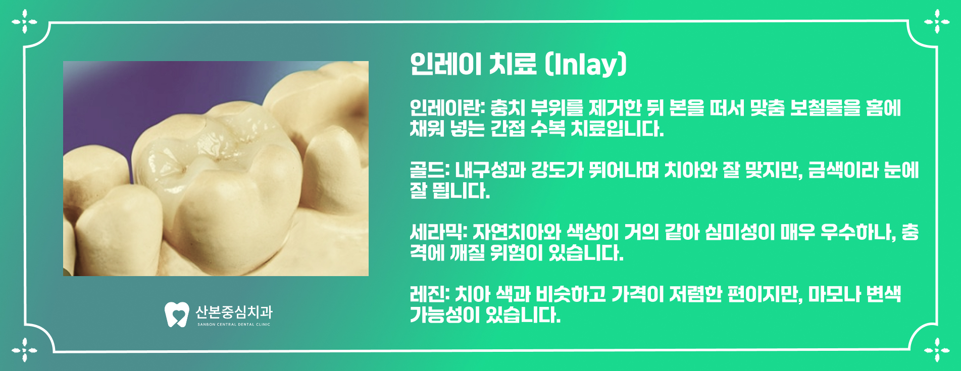 재궁동치과 인레이 치료 – 산본중심치과