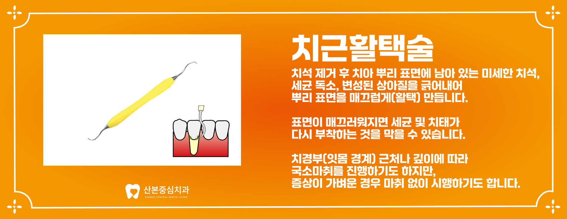 치근활택술 안내 - 산본중심치과
