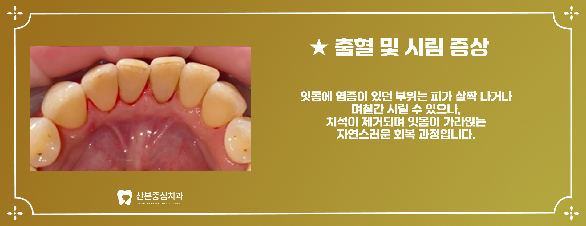 스케일링 후 출혈 및 시림 증상 - 오금동 치과