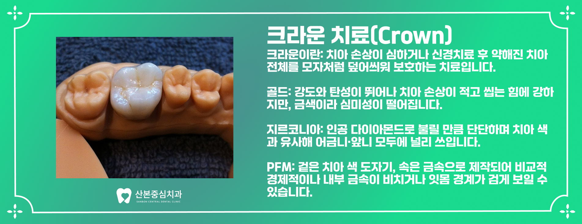 재궁동치과 크라운 치료 – 산본중심치과