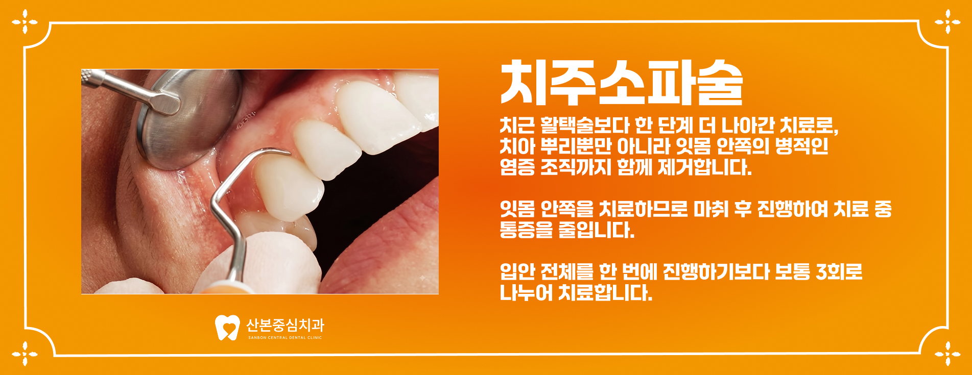 치주소파술 안내 - 산본중심치과