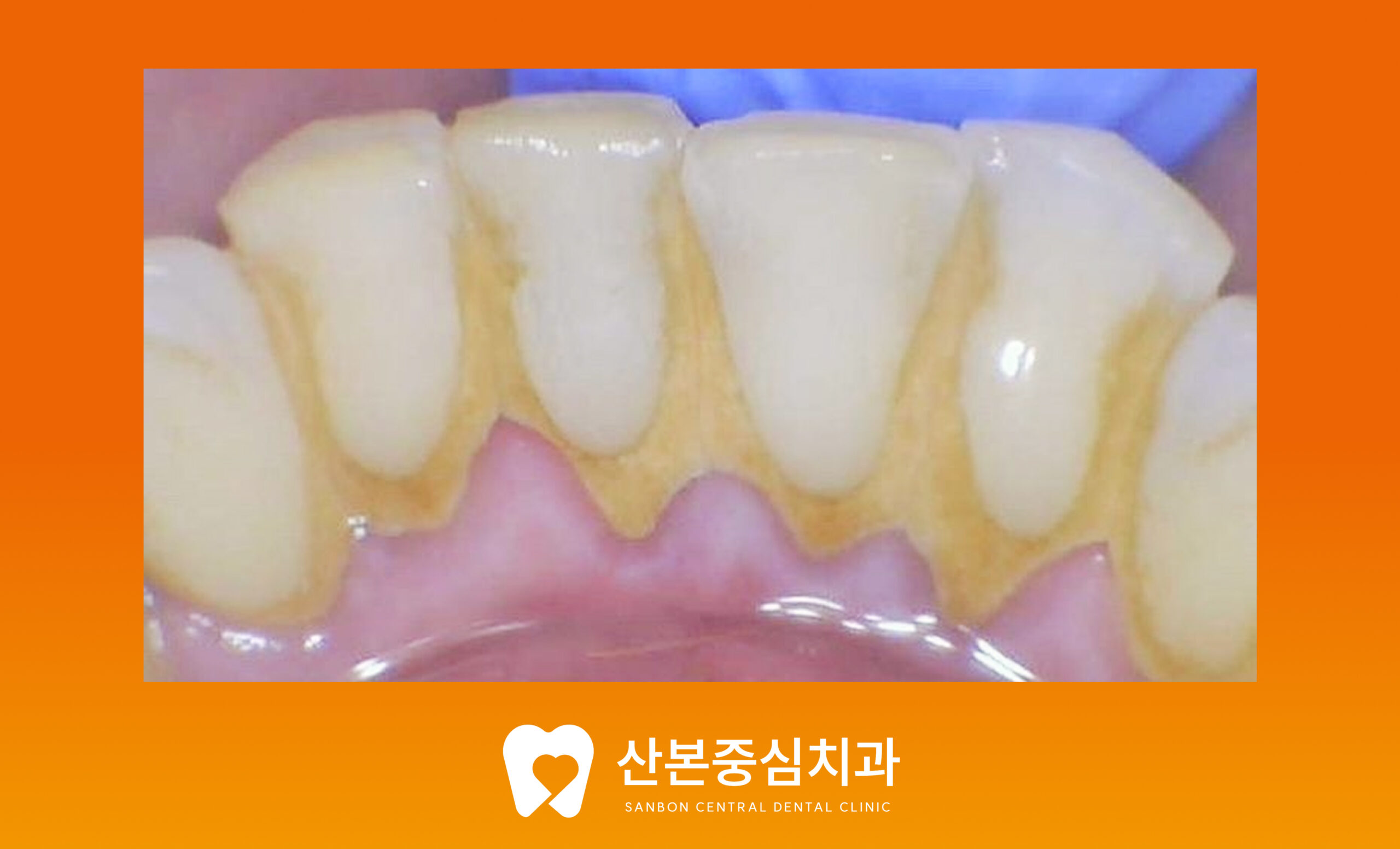치아와 잇몸 경계에 쌓인 치석 - 산본중심치과