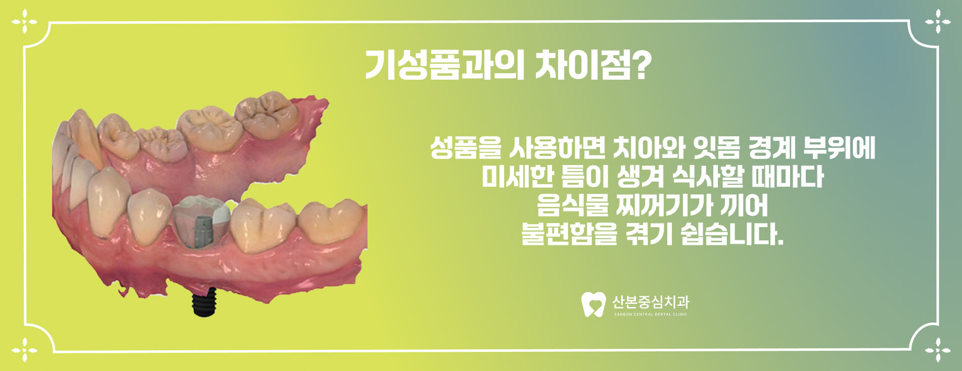 산본역치과 기성품 지대주와 맞춤형 지대주 차이점 – 산본중심치과