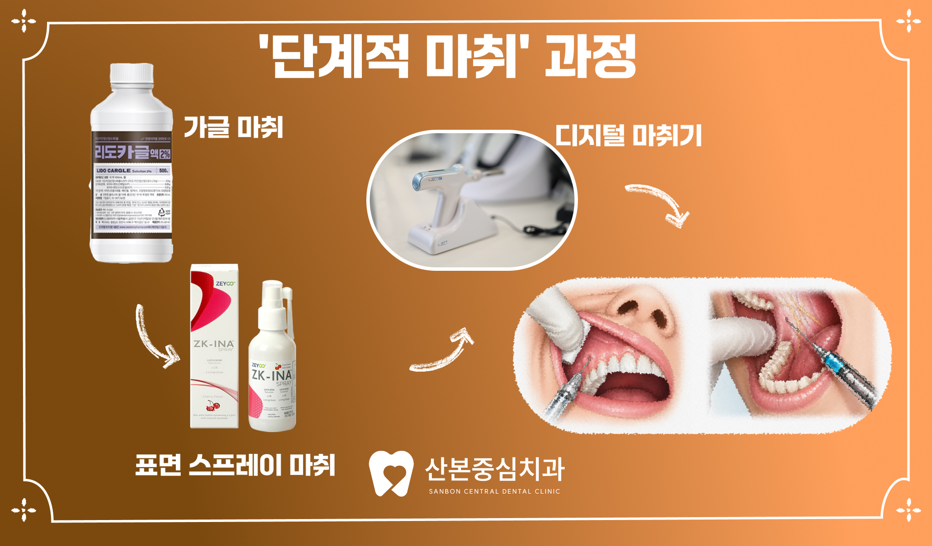재궁동치과 단계별 마취 과정 – 산본중심치과