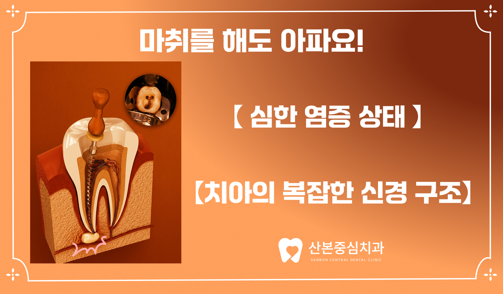 재궁동치과 마취해도 아픈 이유 – 산본중심치과