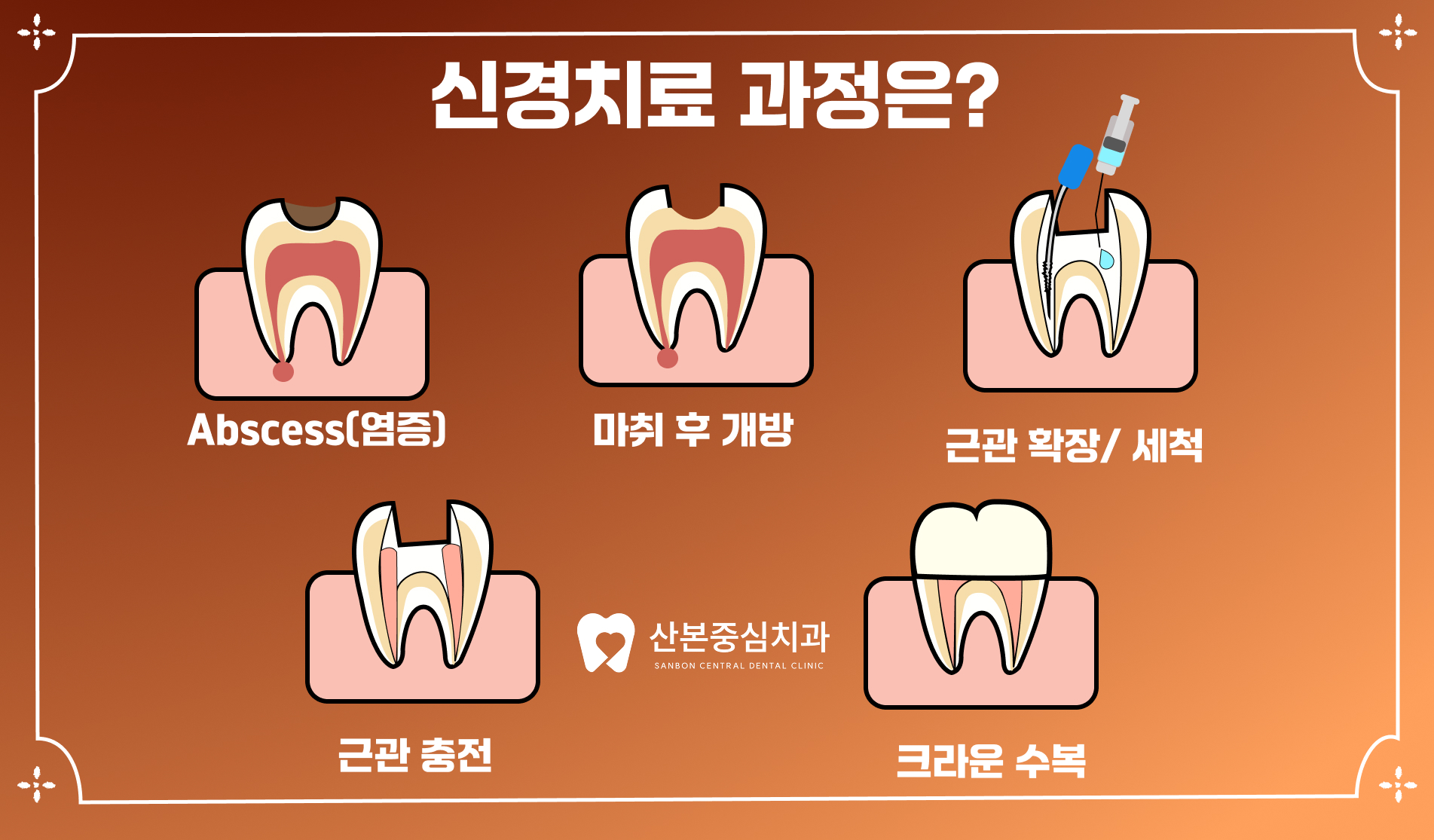 재궁동치과 신경치료 과정 – 산본중심치과