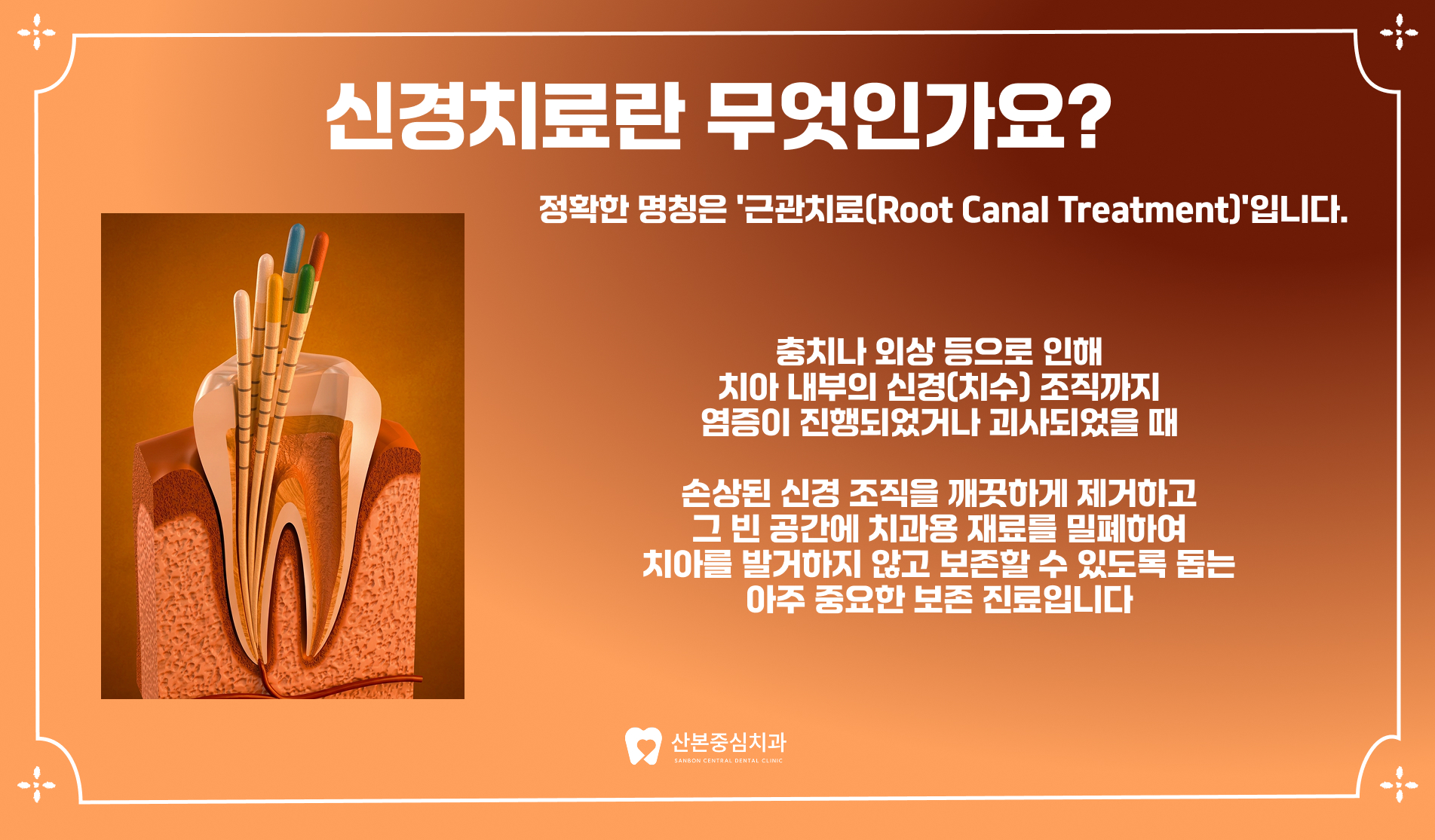 재궁동치과 신경치료란 무엇인가요 – 산본중심치과