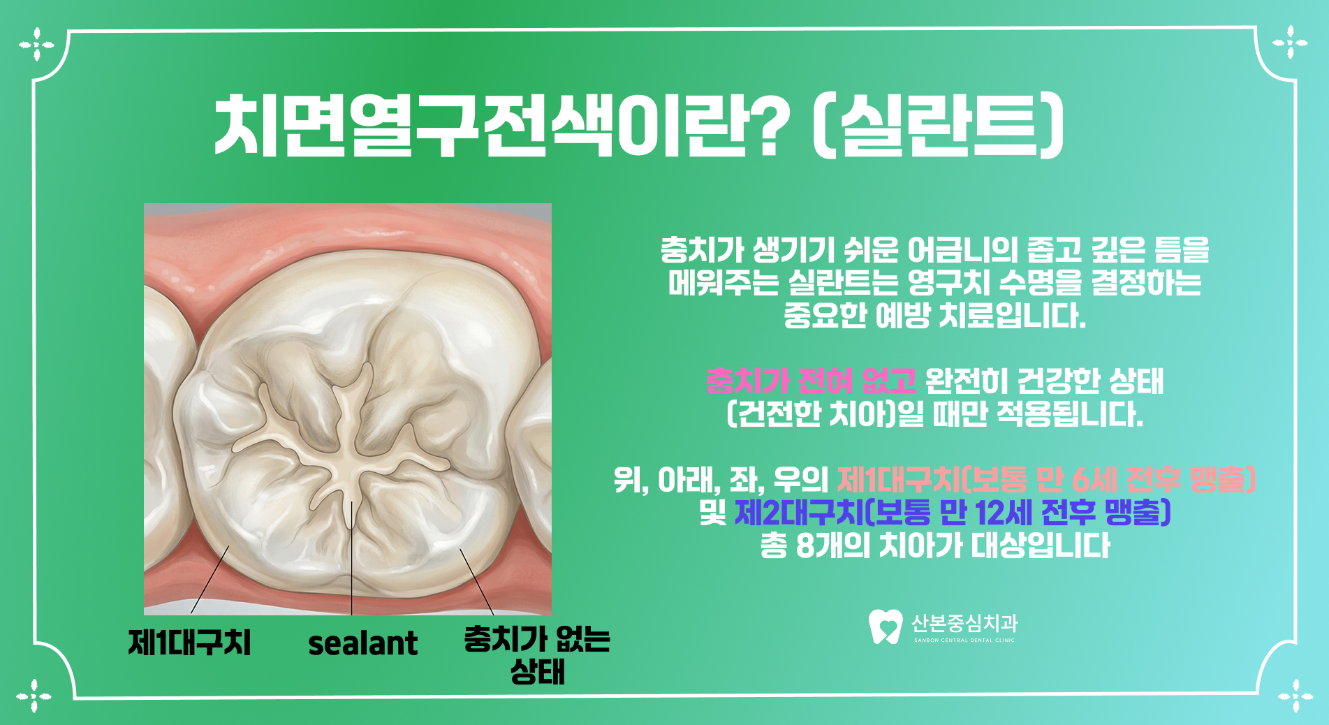 산본역치과 치면열구전색 실란트란 – 산본중심치과