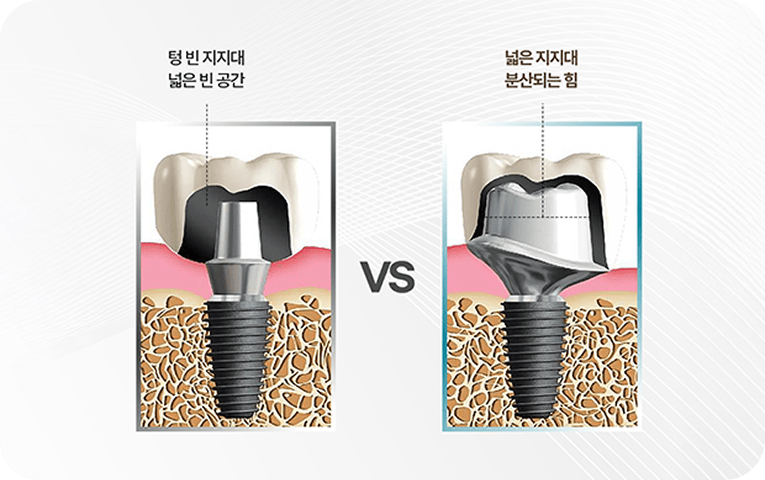 일반과 맞춤형 지대주의 차이
